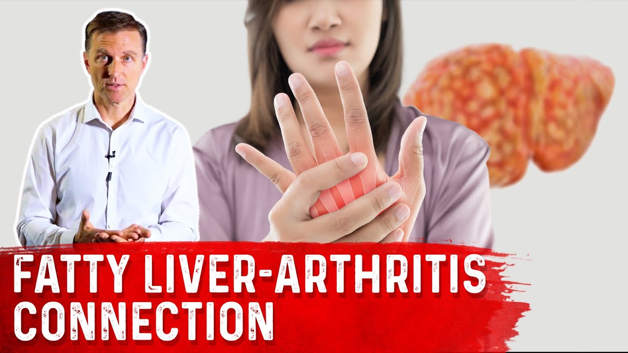 Why Does a Fatty Liver Trigger Arthritis? Fatty Liver Inflammation & Joint Inflammation &ndash; Dr.Berg