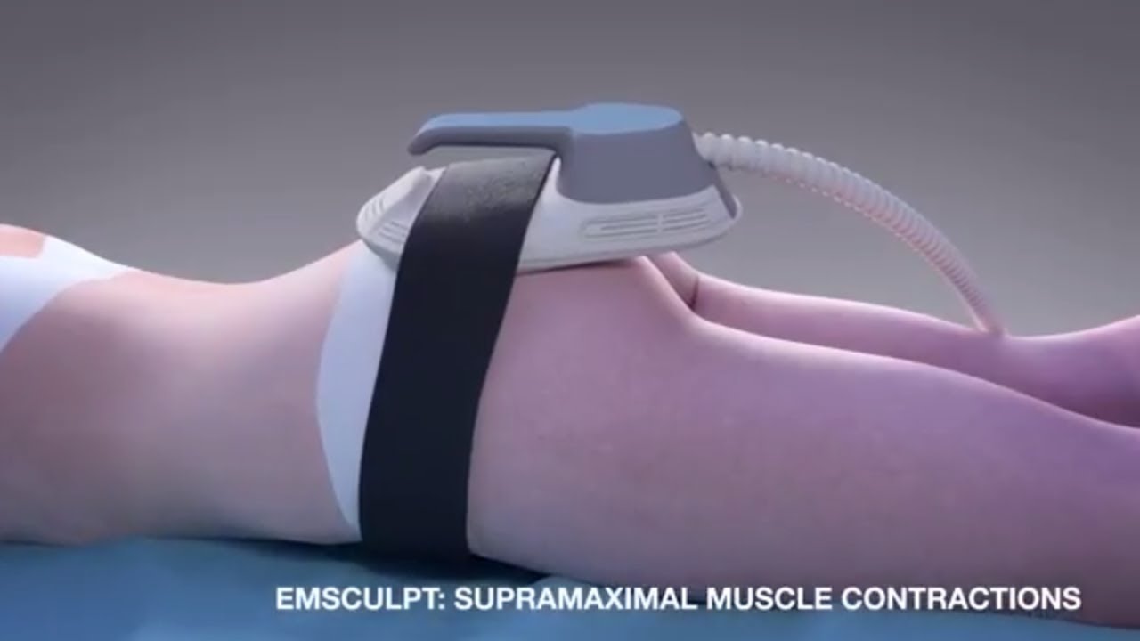 Emsculpt MOA for noninvasive butt lift