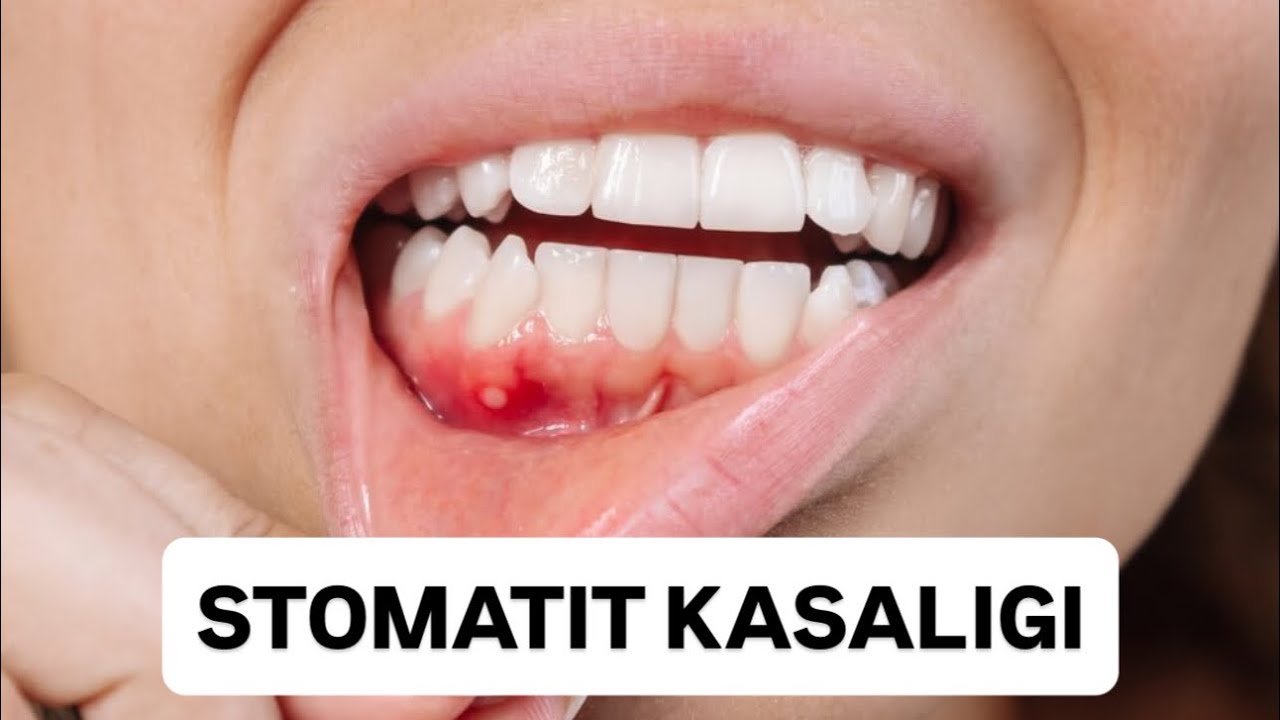 Stomatit kasaligi turlari #stomatolog#shifokor#dentist#doctor#tibbiyot#rek#stomatit