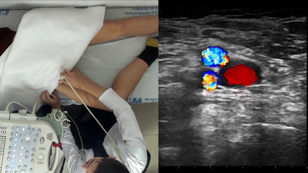 Habilidades prácticas ECOE 5° - Ecografía de TVP