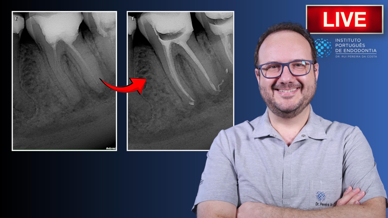 Rtx of 🦷36 with failed Endo treatment | AAP ▶️ Single Session | CASE328