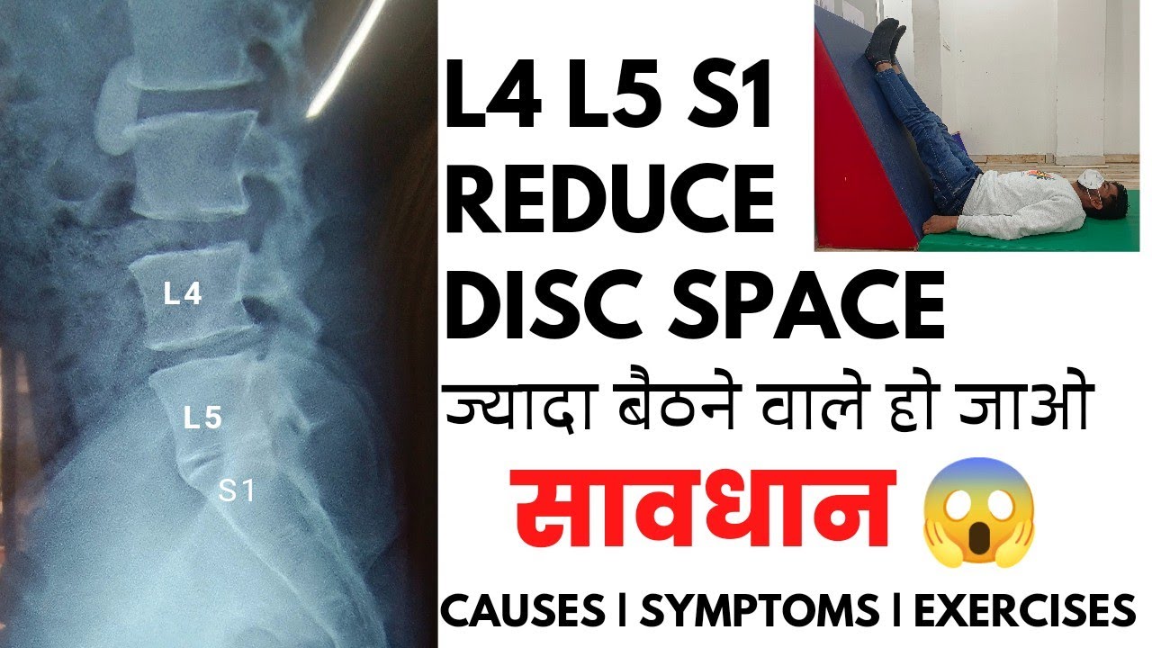 L4-L5 and L5-S1 reduced disc space exercises in Hindi | Disc space narrowing L5-S1 treatment
