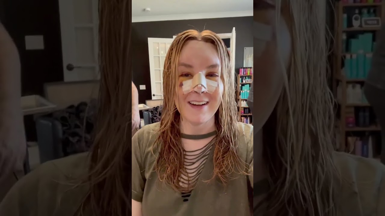 Facial Feminization Surgery (FFS) Vlog