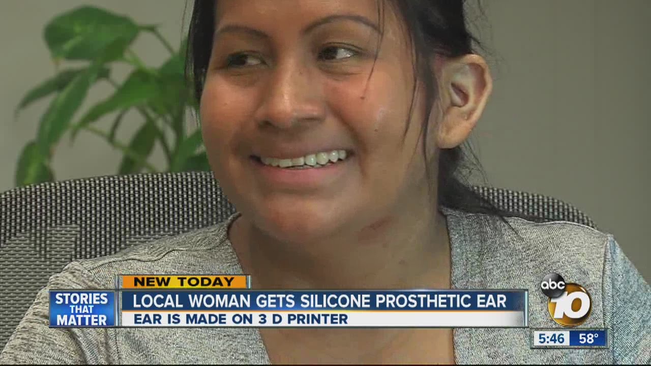 San Diego woman gets silicone prosthetic ear