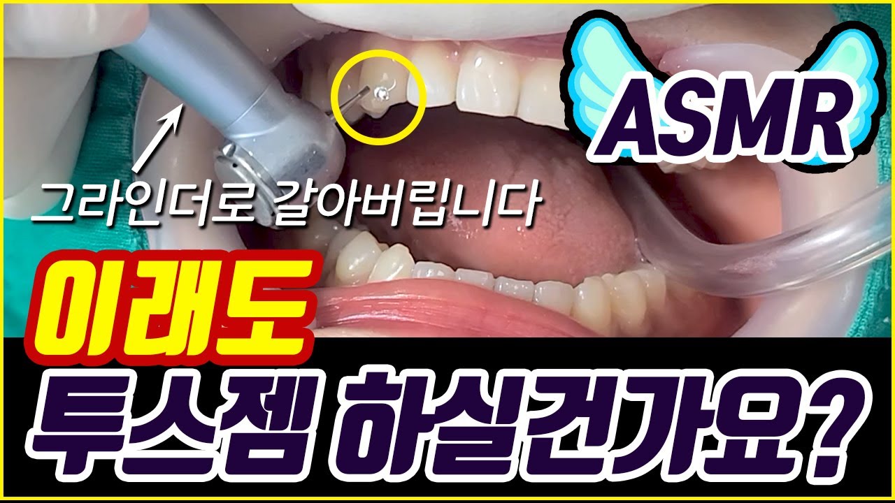 치과ASMR 투스젬 제거하기 (하이스피드,로우스피드 핸드피스 소리,레진 갈리는 소리,치과 공포증 극복, tooth gem removal tool)