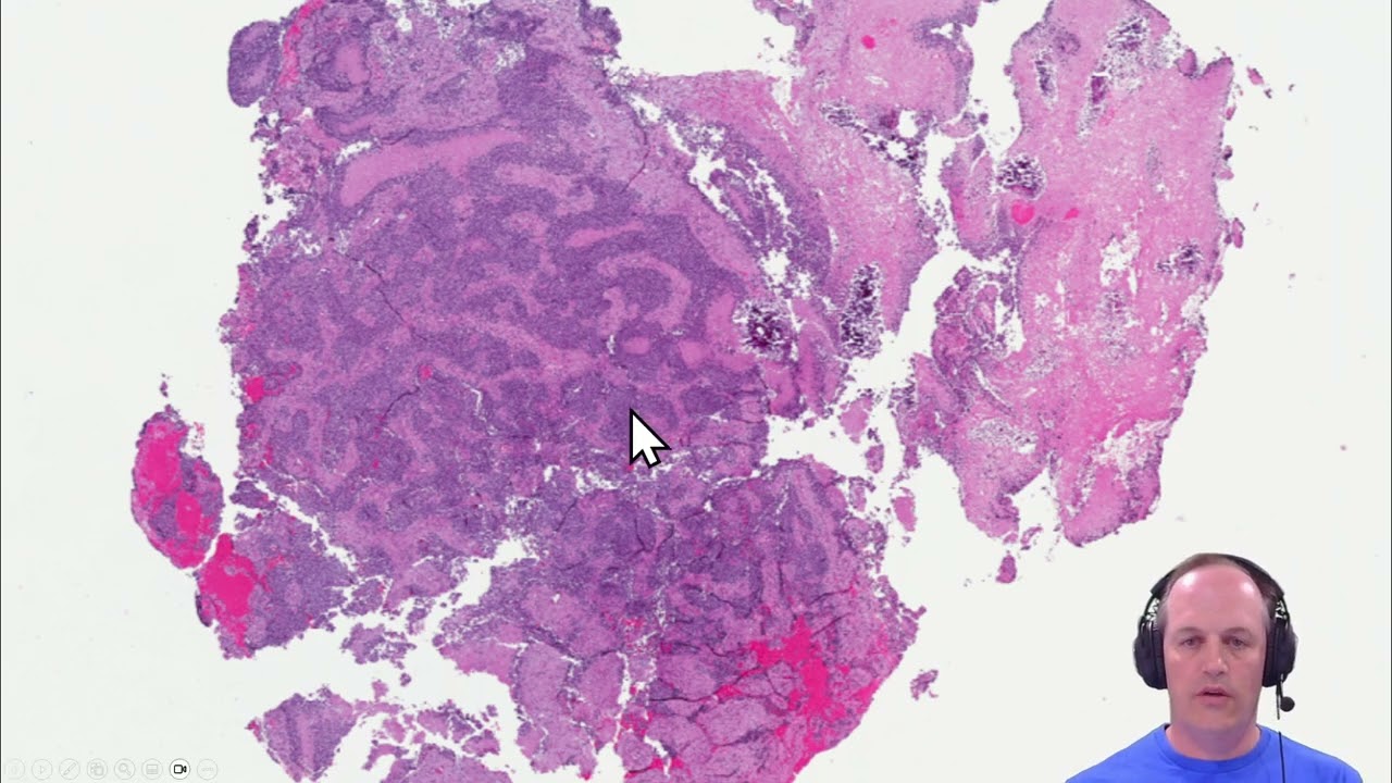 Guide to Pediatric Small Round Blue Cell Tumors - Ewing Sarcoma