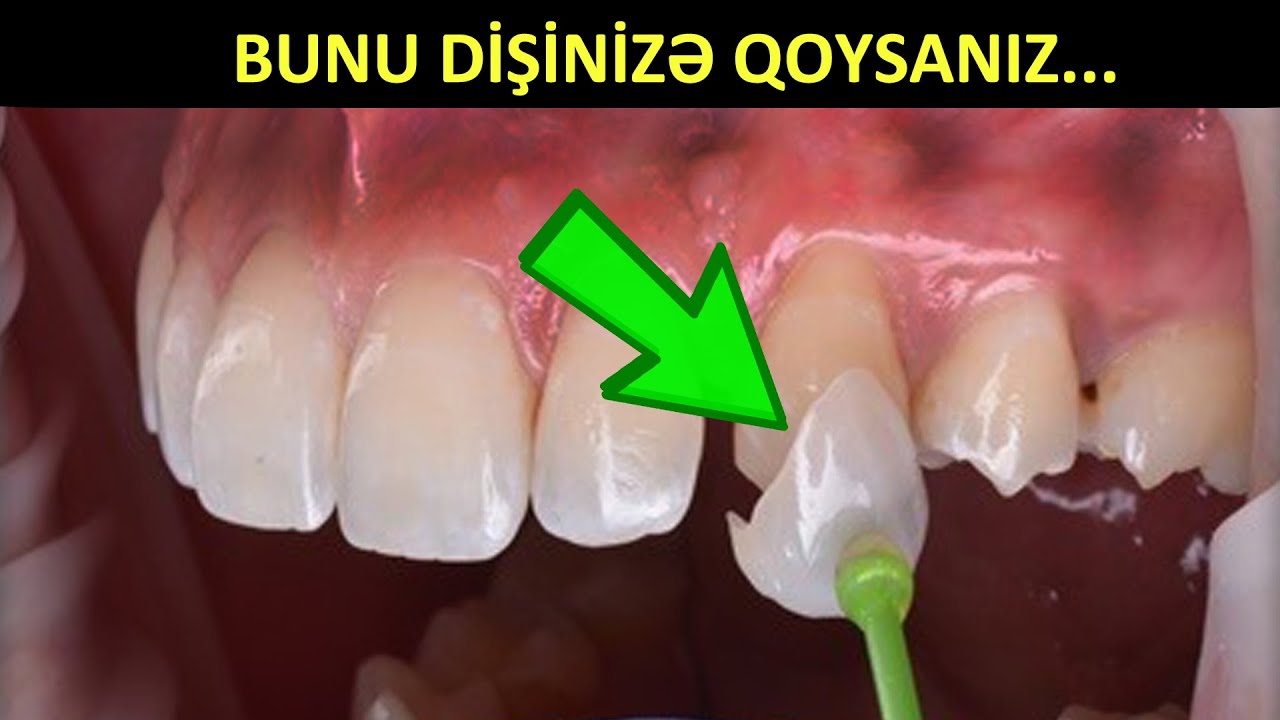 Dişləriniz əyridirsə BAXIN - BUNDAN istifadə edin