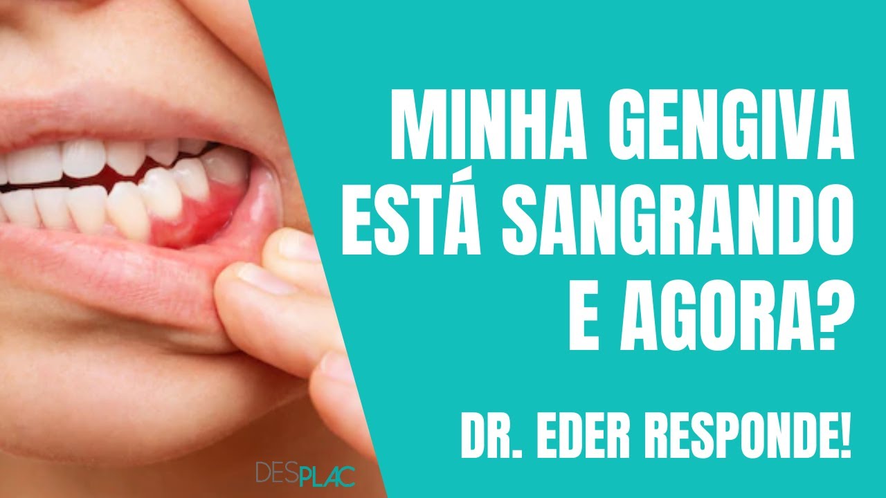 GENGIVA SANGRANDO E AGORA? - DR. EDER RESPONDE