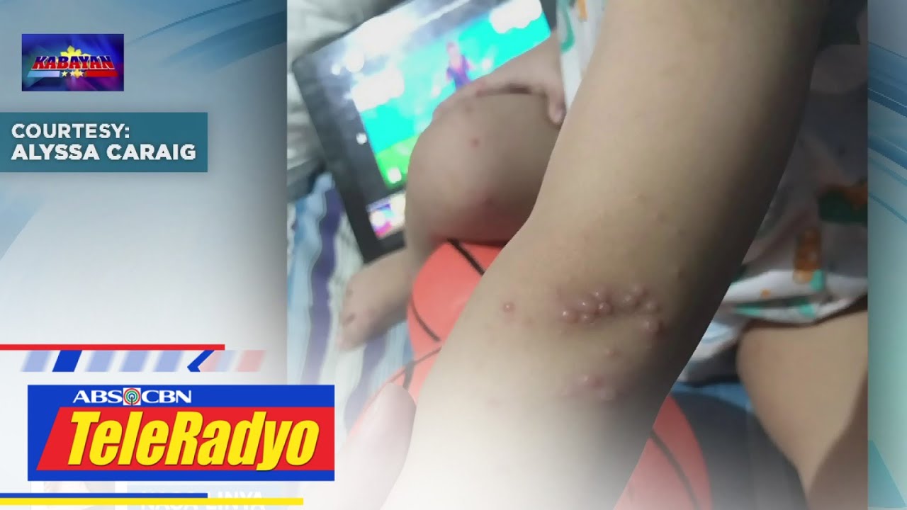 ALAMIN: Ano ang mga sintomas ng hand, foot, and mouth disease? | Kabayan (7 Dec 2022)