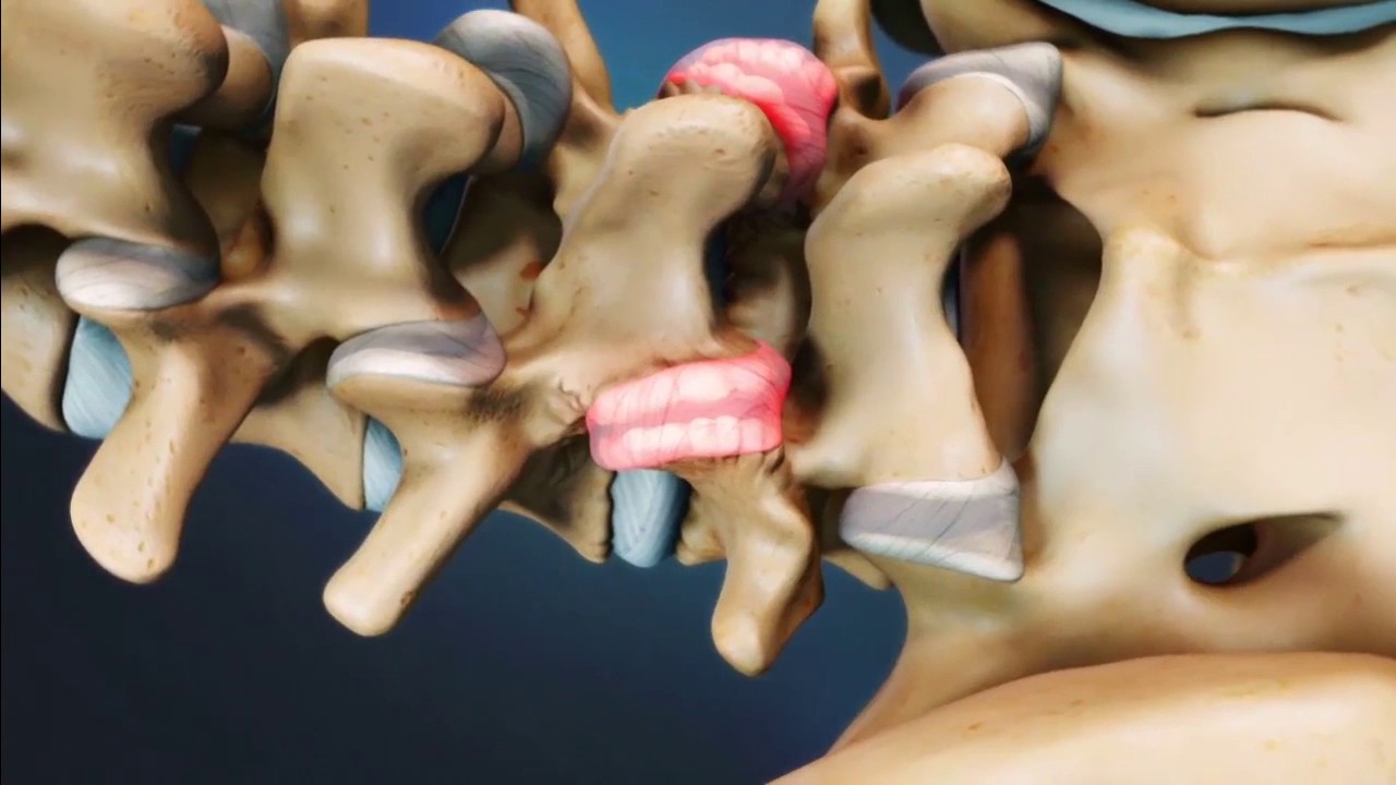 Блокады фасеточных суставов