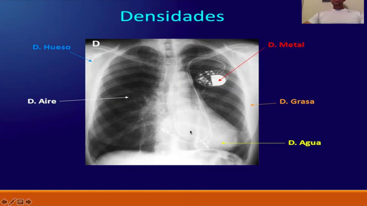 Densidades en Radiología