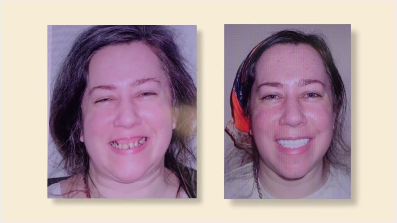 Ora Dentistry | Yomi Robot Dental Implant Patient Testimonial | Sacramento, Elk Grove, CA