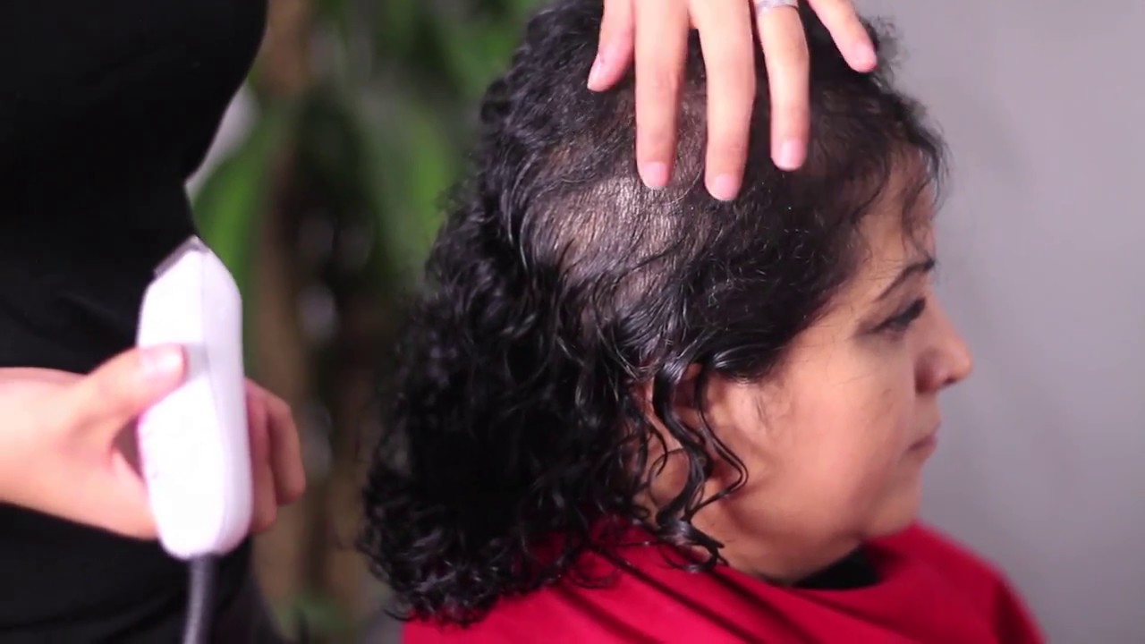 ALOPECIA FEMENINA SOLUCION INMEDIATA SIN CIRUGIA PROTESIS CAPILAR FEMENINA