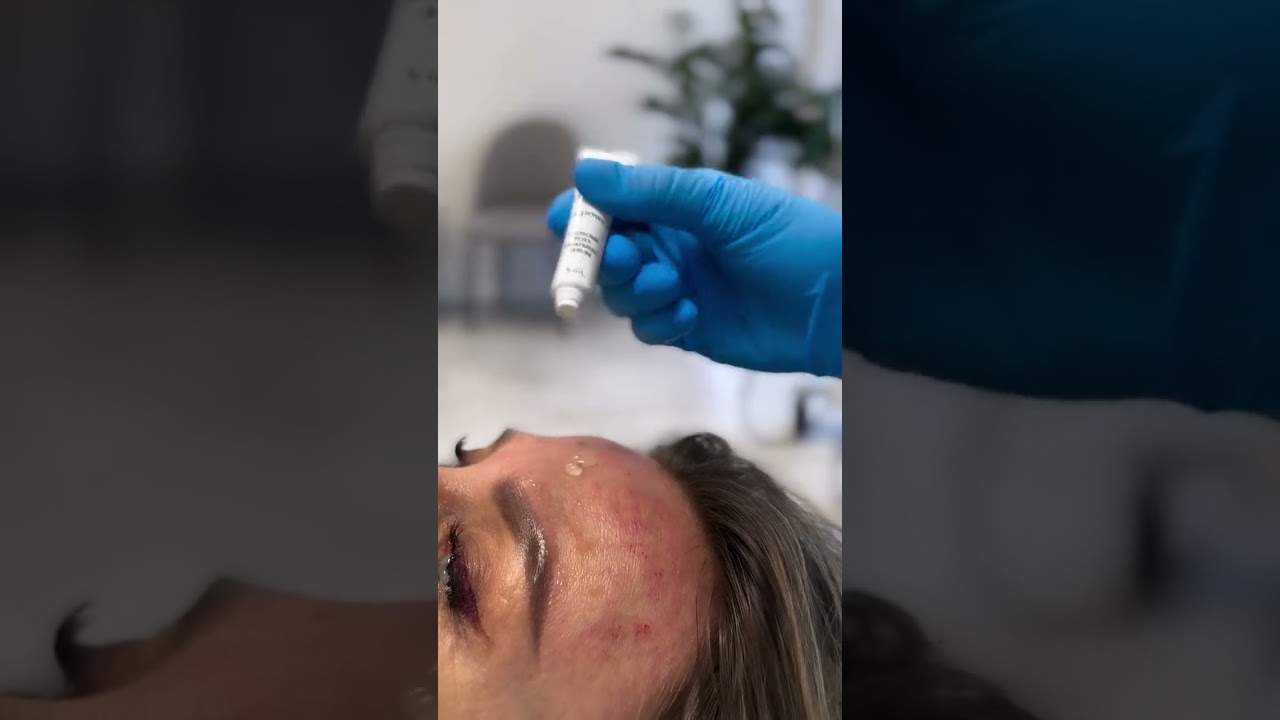 Egzozomi za lice uz dermapen tretman &ndash; Elevai Empower&trade; regeneracija kože | Rejuva Beograd