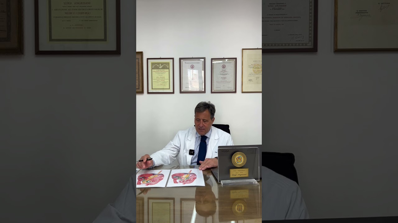 Cos'è L'intervento di Bypass Gastrico