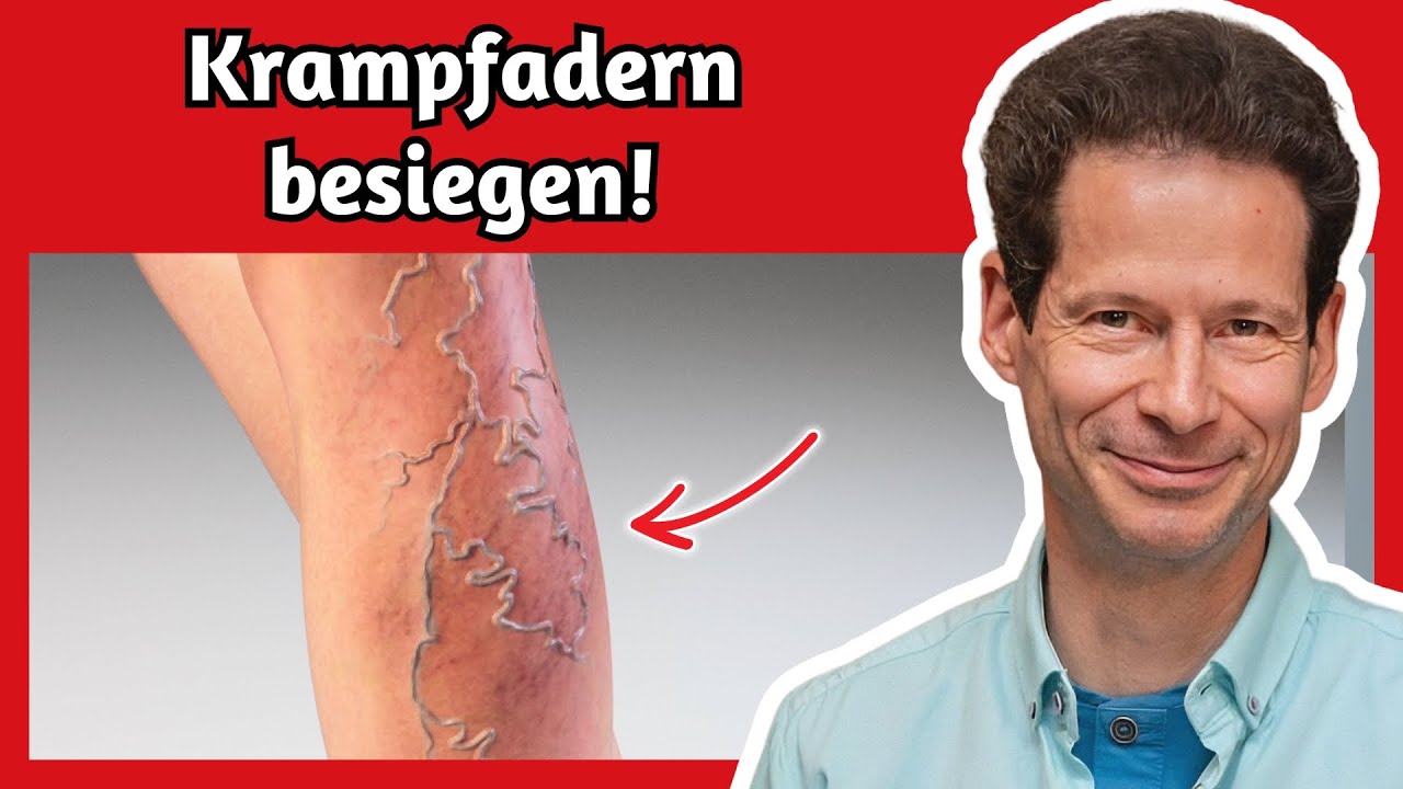 Krampfadern - Verstehen, behandeln und verhindern: Experten-Tipps mit Dr. Hartmut Fischer