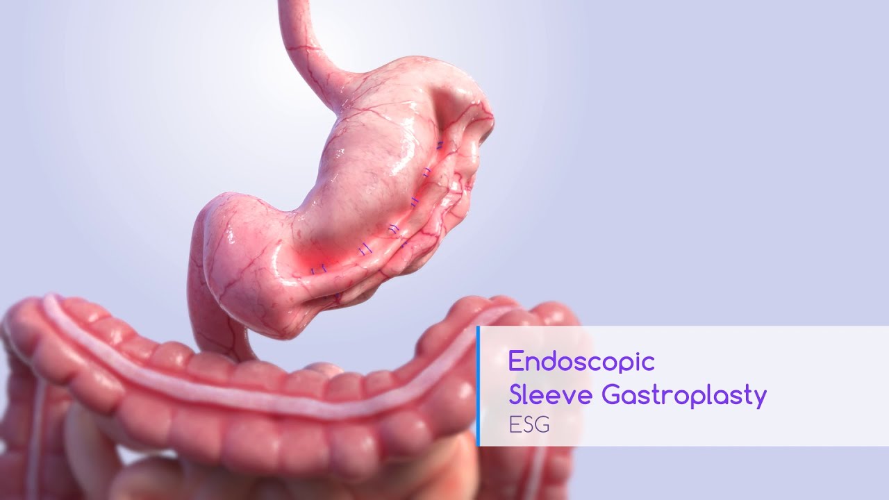 Endoscopic Sleeve Gastroplasty Animation- Apollo ESG System