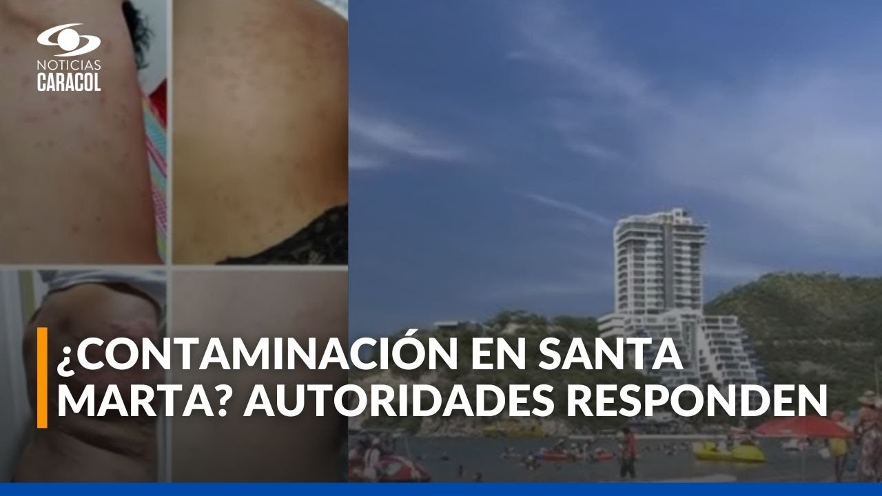 Turistas reportan brotes en la piel tras bañarse en el mar de Santa Marta: ¿qué pasó?
