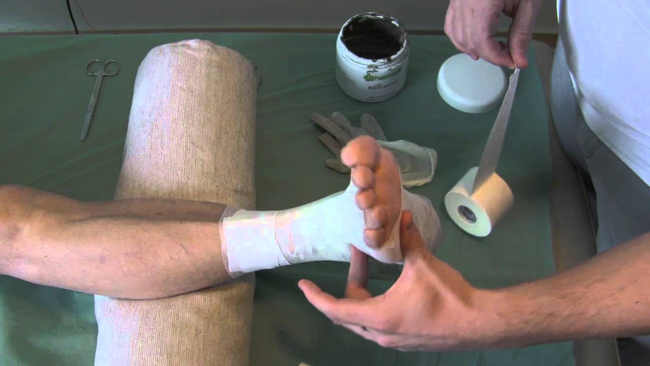 Fasciatura caviglia con argilla distorsione