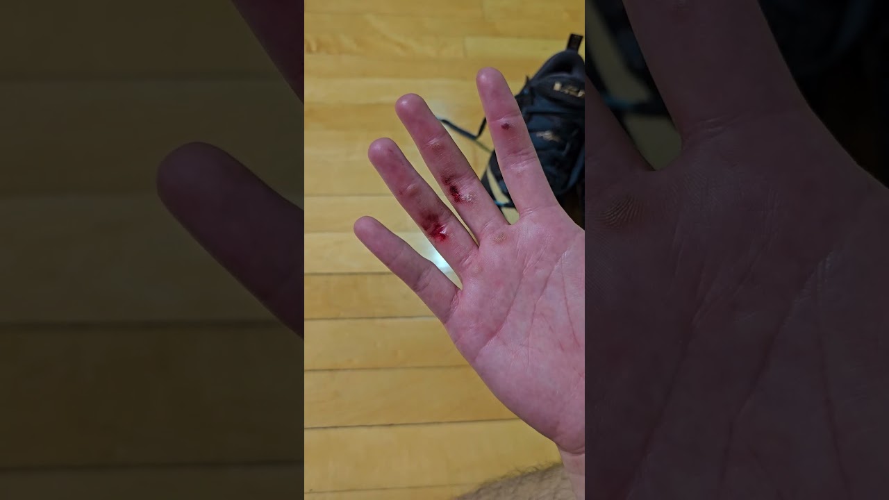 Tag a HOOPER who has this problem 🤕🏀