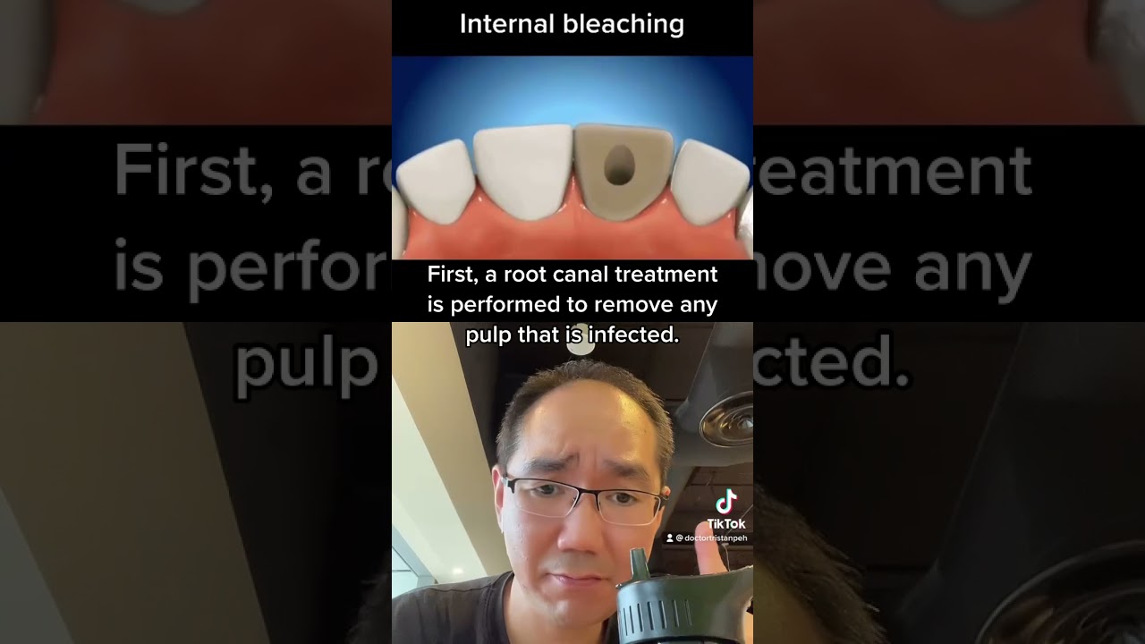 How internal whitening on a dead tooth? 🧐