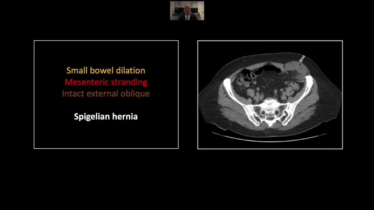 Small Bowel Emergencies, Part 2 | Interesting Radiology Cases