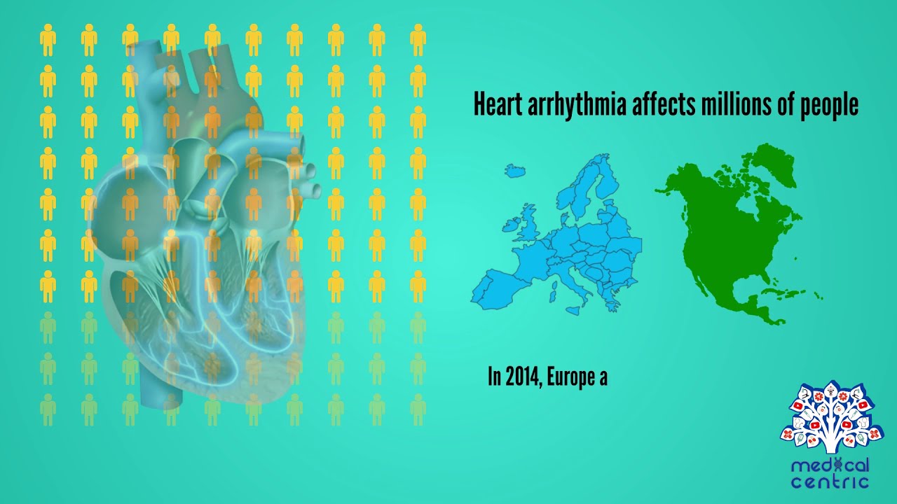 Heart Arrhythmia, Causes, Signs and Symptoms, Diagnosis and Treatment.