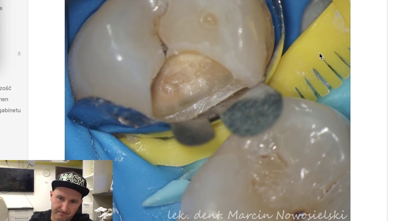 Dental MacGyver - Tips & Tricks e1 (en): Two wedges trick, missing teeth, wide interdental space.