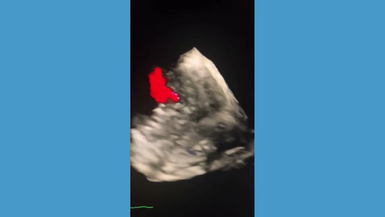 Post-infarct VSD with several smaller defects with the surrounding muscular tissue