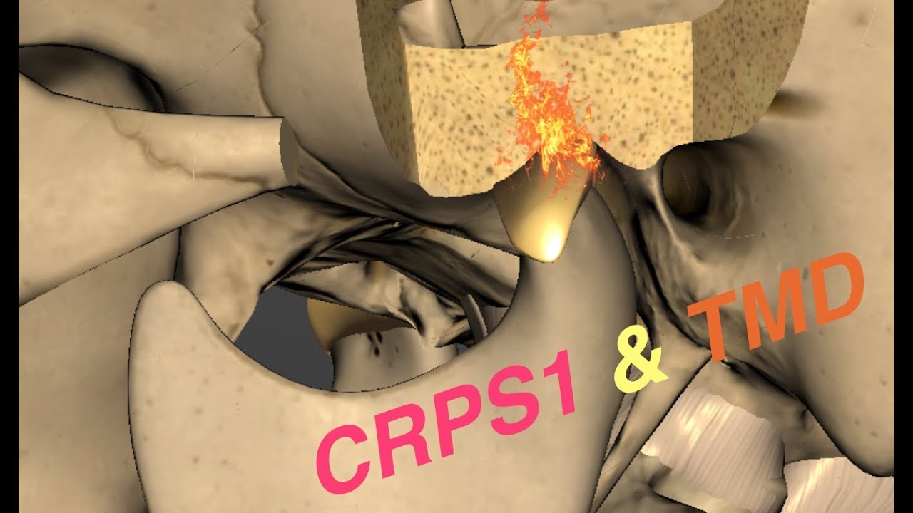TMD patients with extreme pain can have CRPS Type 1 of the head and neck-a case study