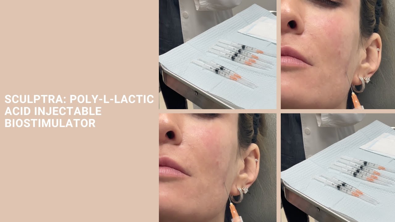 Sculptra: Poly-L-lactic Acid Injectable Biostimulator