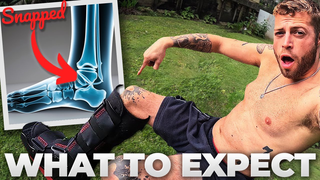 Life after BREAKING my ANKLE - Trimalleolar Fracture