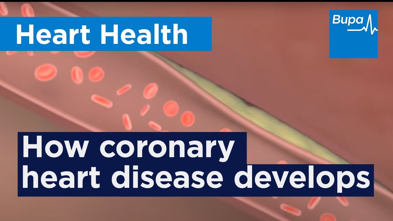 How coronary heart disease (atherosclerosis) develops | Bupa Health
