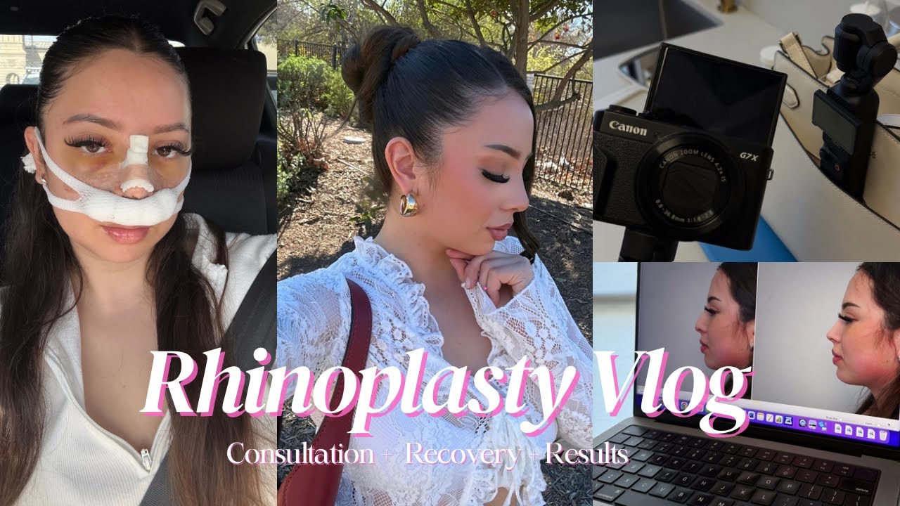 My Rhinoplasty Vlog with Dr. Grigoryants | Alexandra Rodriguez
