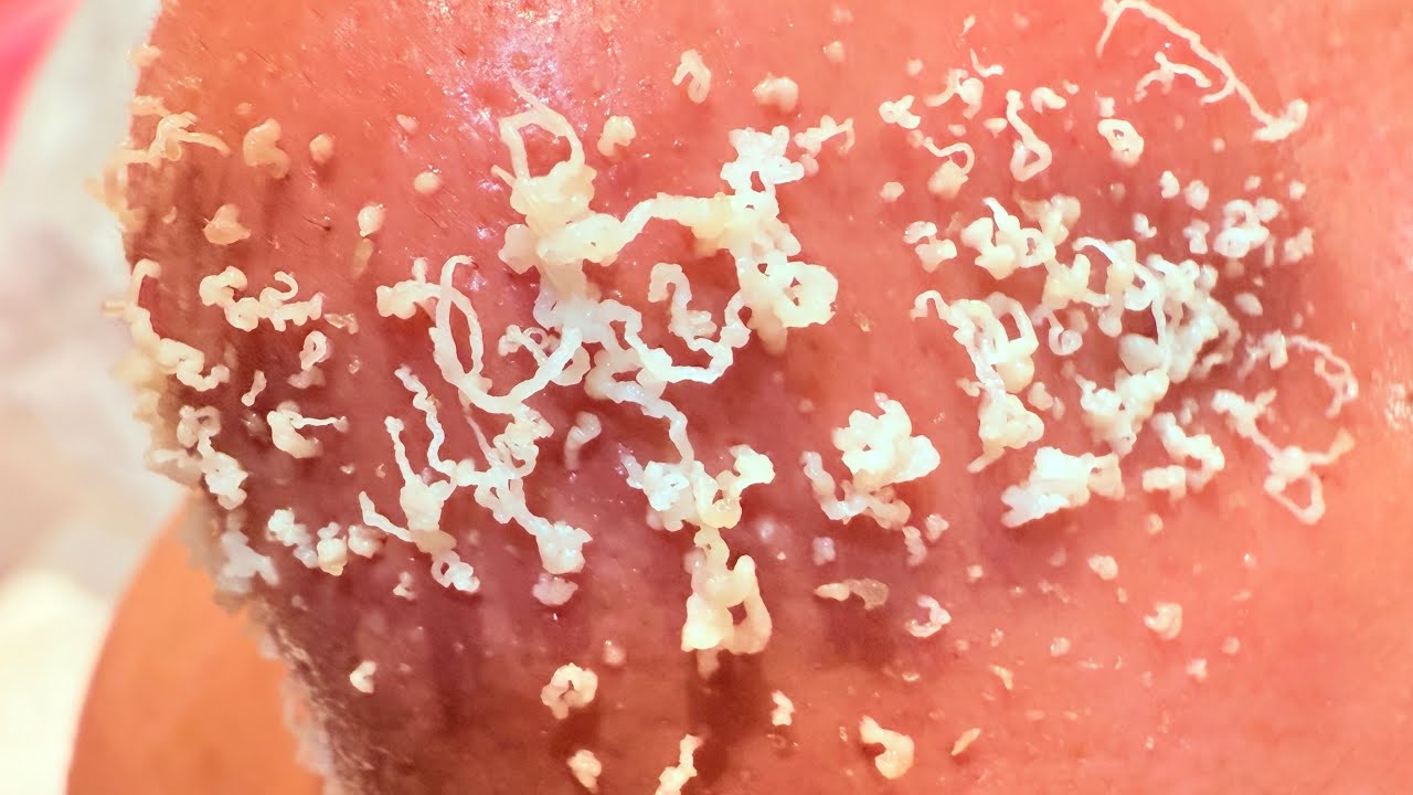Every Day removal Black heads 