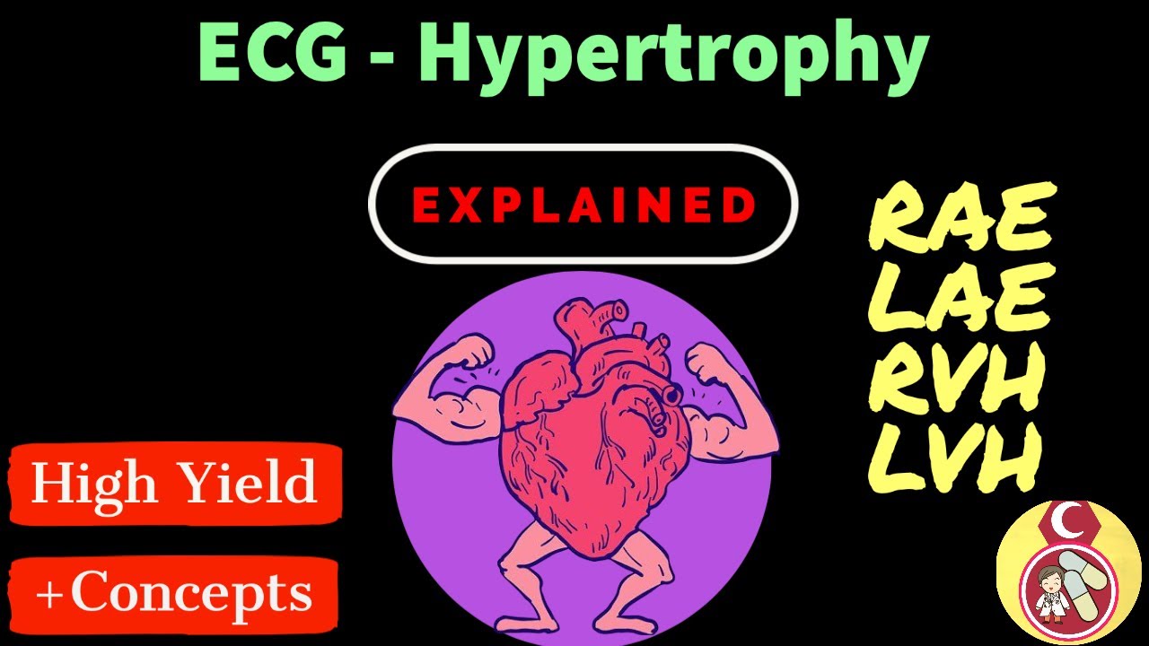 ECG Crash course - #13 Hypertrophy (RAE - LAE - RVH - LVH)