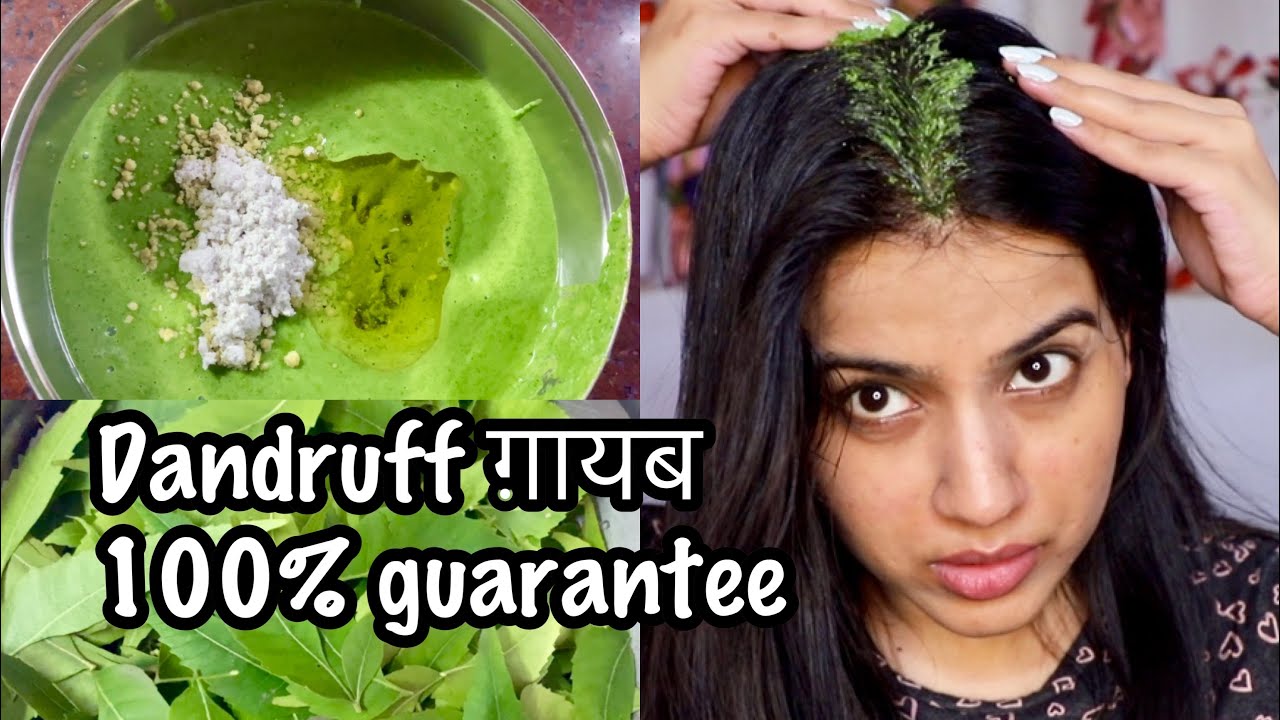 BEST HAIR MASK FOR DANDRUFF | Dandruff Treatment at Home | How To Remove Dandruff, Stop Hairfall