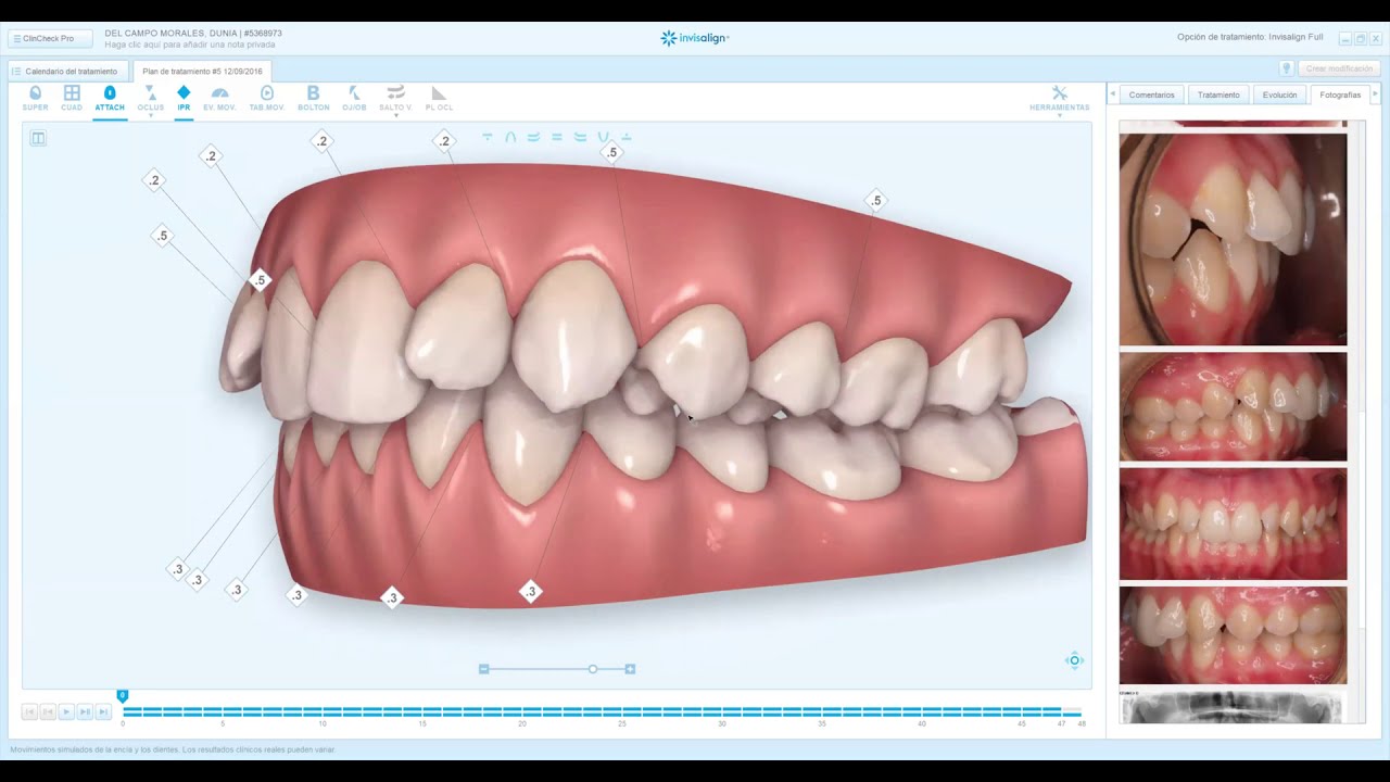 Dr. Susana Palma Moya- clincheck 2: Correction by simultaneous distalization