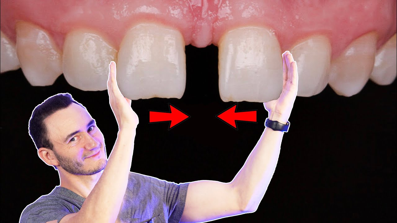 Espacio entre los dientes | Tratamientos para cerrar un 