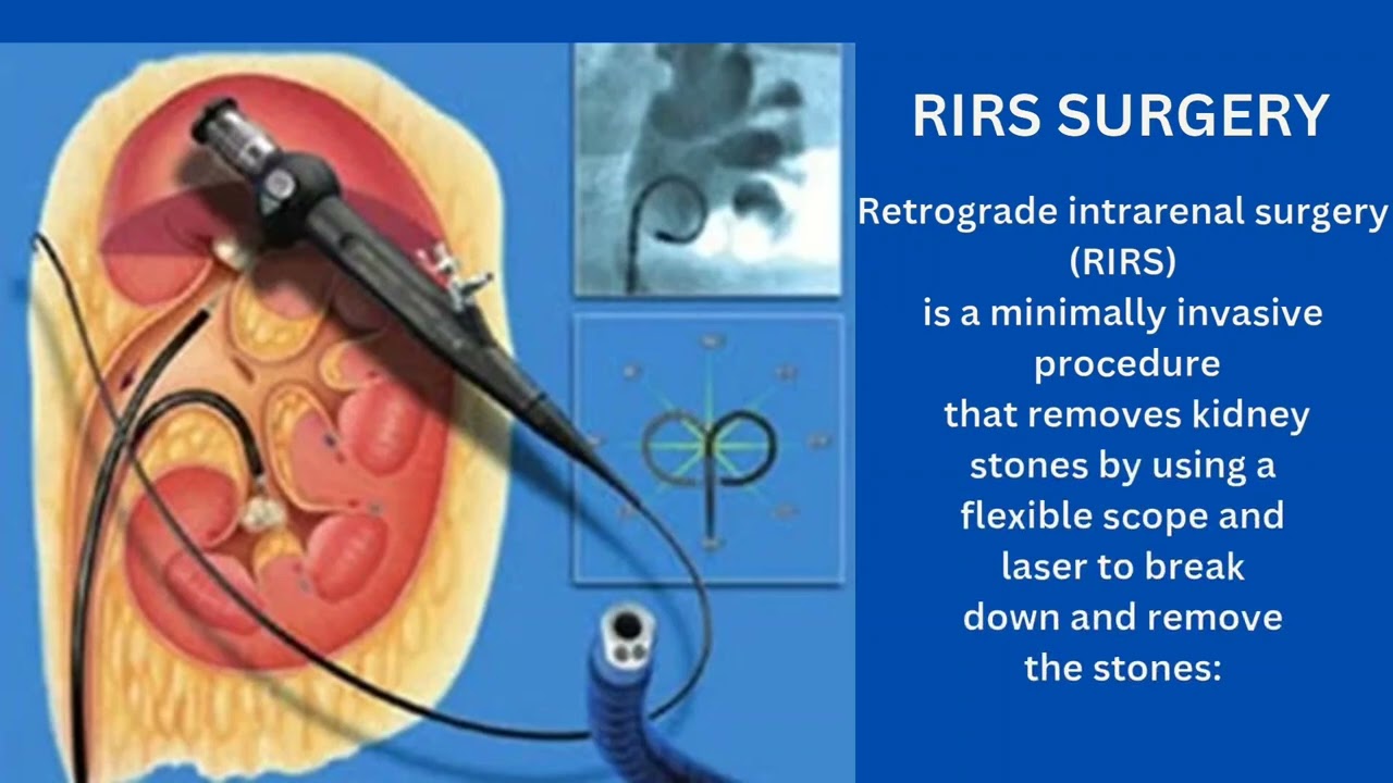 Urology Solutions for Advanced Laparoscopic Treatments 