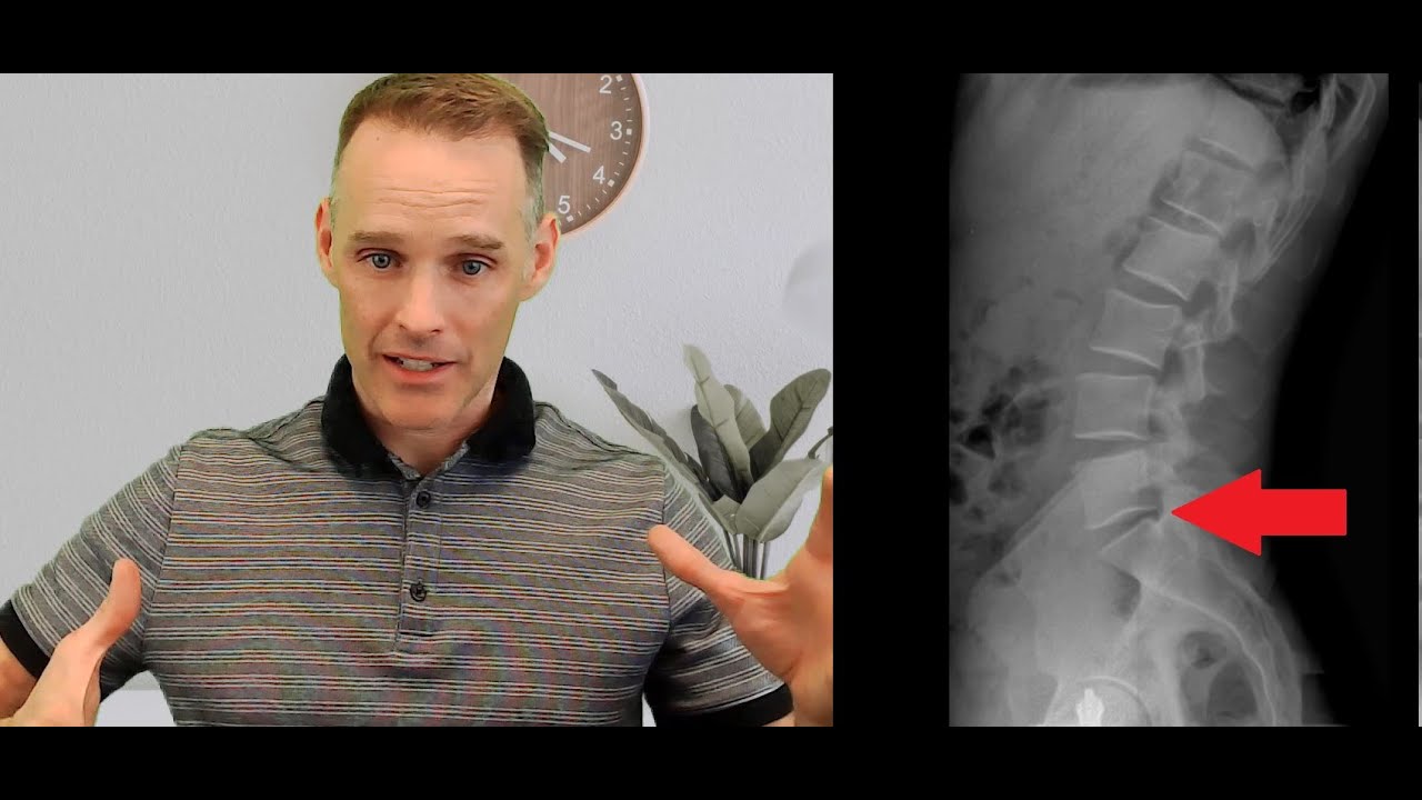 Looking at X-Rays of a 46 Year-Old-Man - Rare Lower Back Injury!