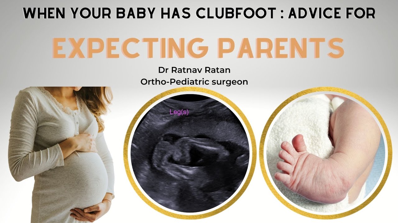 𝗪𝗵𝗲𝗻 𝘆𝗼𝘂𝗿 𝗯𝗮𝗯𝘆 𝗵𝗮𝘀 𝗰𝗹𝘂𝗯𝗳𝗼𝗼𝘁: 𝗔𝗻𝘀𝘄𝗲𝗿𝘀 𝗳𝗼𝗿 𝗲𝘅𝗽𝗲𝗰𝘁𝗶𝗻𝗴 𝗽𝗮𝗿𝗲𝗻𝘁𝘀|𝗖𝗹𝘂𝗯𝗳𝗼𝗼𝘁 𝗶𝗻 𝗽𝗿𝗲𝗴𝗻𝗮𝗻𝗰𝘆