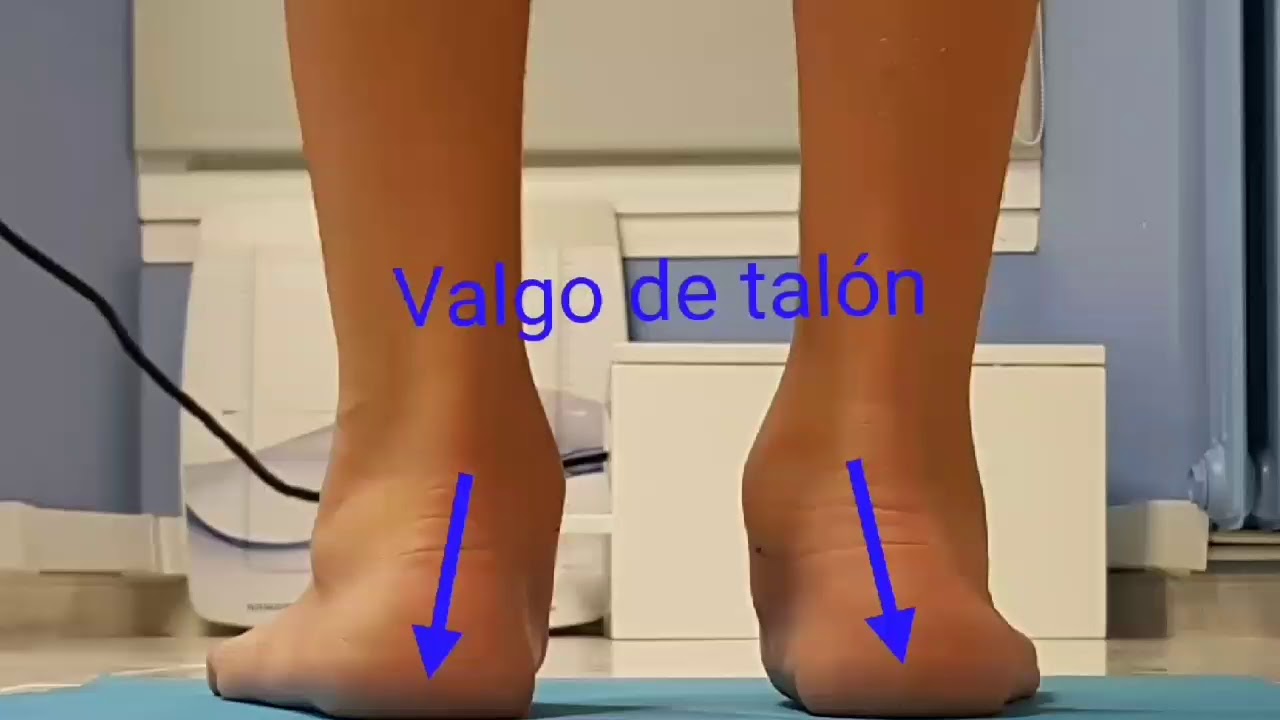 Pie plano en Niño