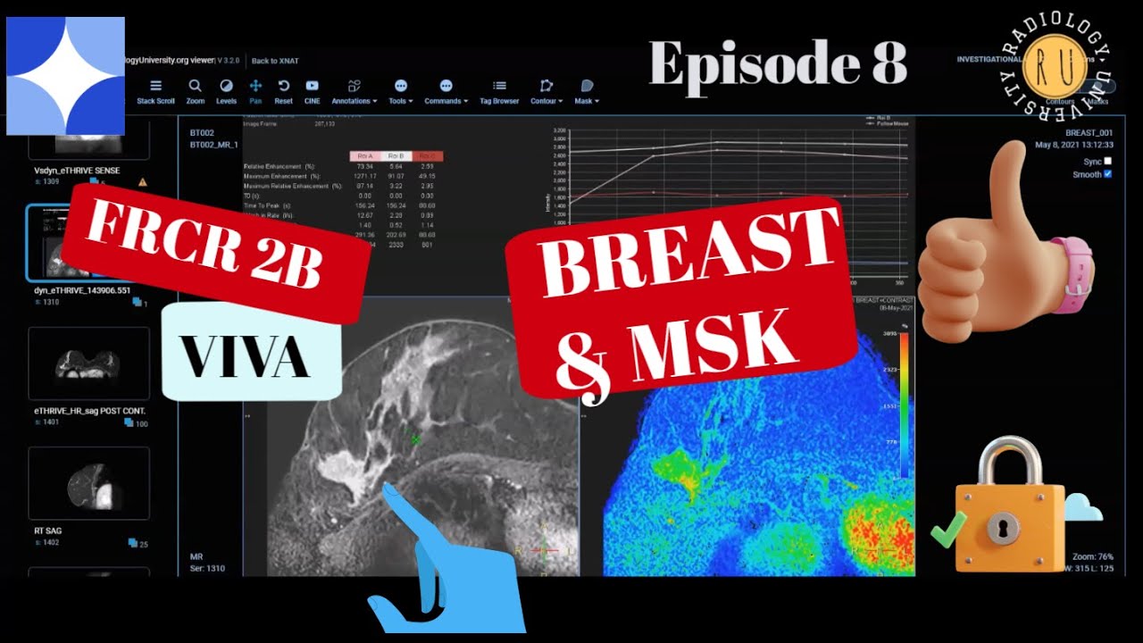 Episode 8: FRCR 2B viva experience part 4, Breast & MSK cases