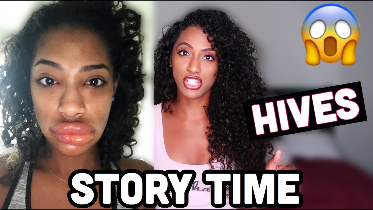 STORY TIME ON CHRONIC HIVES **EMOTIONAL**