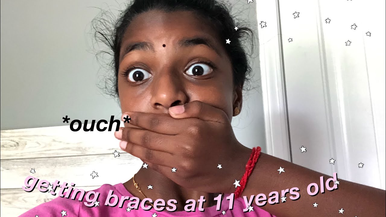 SUPER FAST BRACES VLOG! *funny*