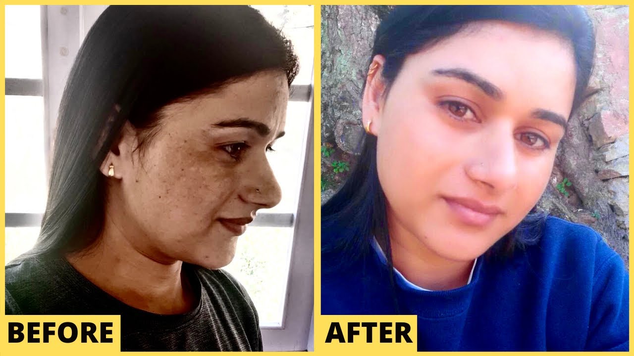 90% Melasma gone in 3 months. 5 साल की झाइयाँ 3 महीनों में चली गयी ओर मेरी सेहत भी बन गयी ।