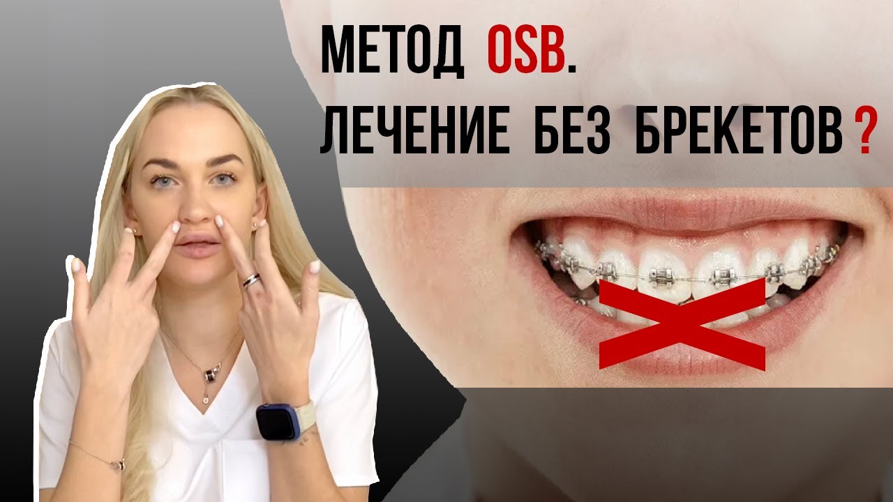 Cистема OSB, как альтернативе лечению на брекетах🧐