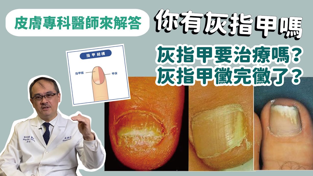 【皮膚專科醫師來解答】灰指甲要治療嗎？灰指甲黴完黴了？皮膚專科醫師張英睿解說10個灰指甲病患最常問的問題(可選翻譯)