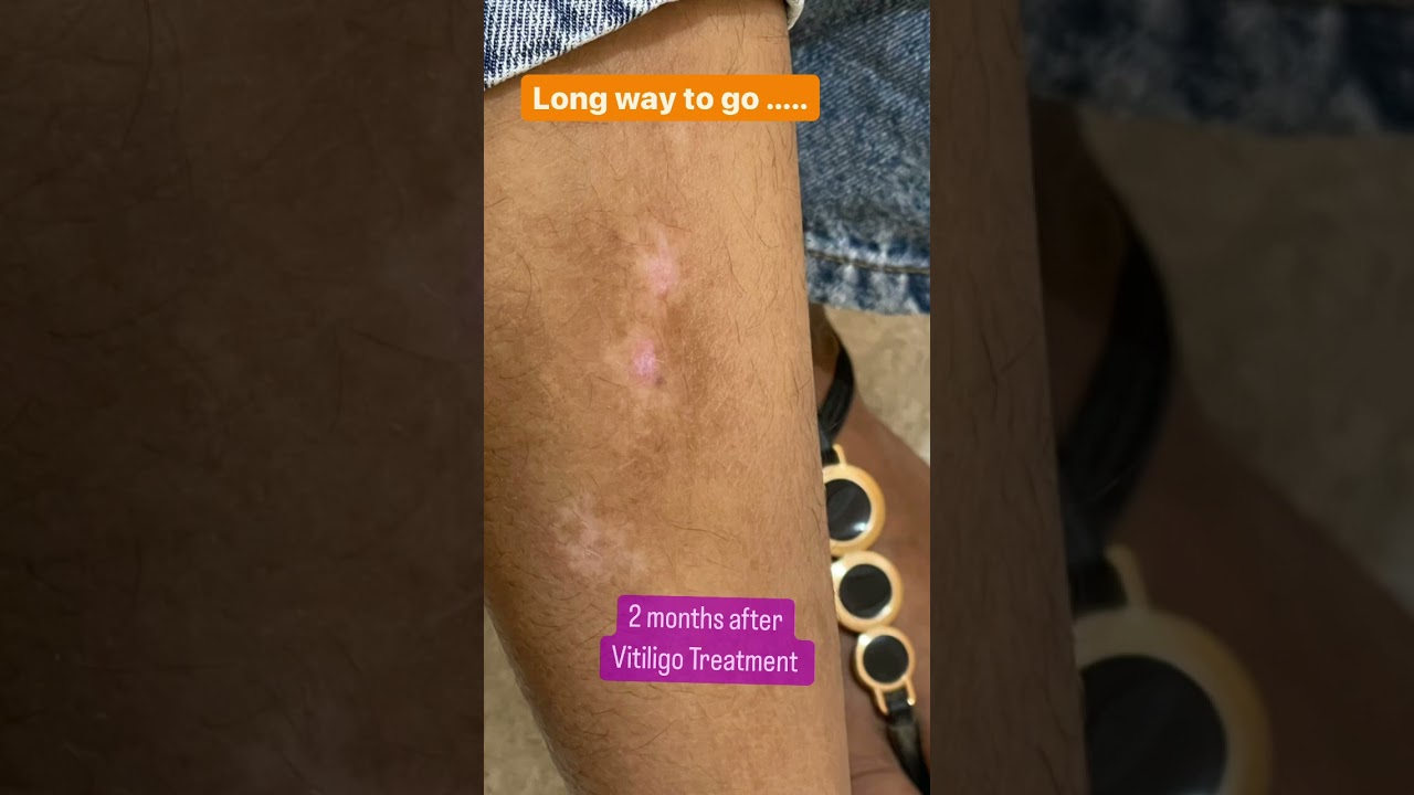 Vitiligo Treatment in Chandigarh| Dermatologistinchandigarh chandigarh #shorts
